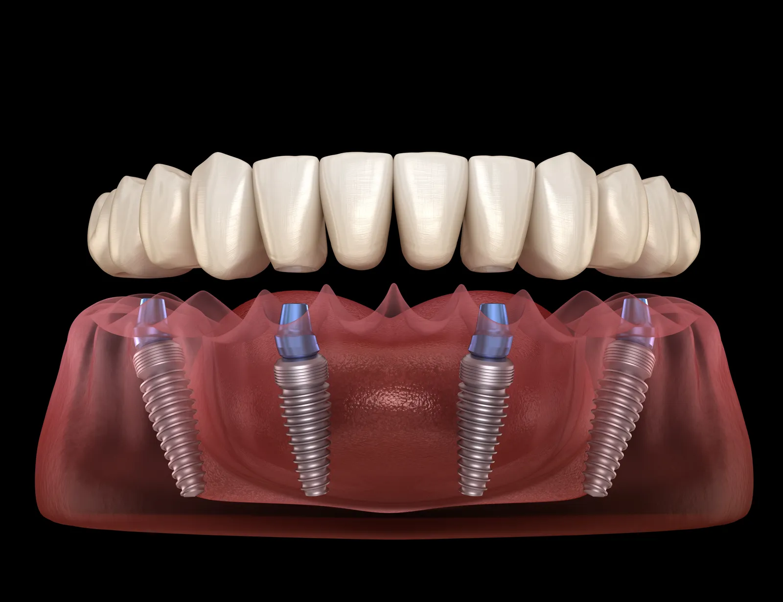 All-on-4 full arch dental implant restoration on four implant posts