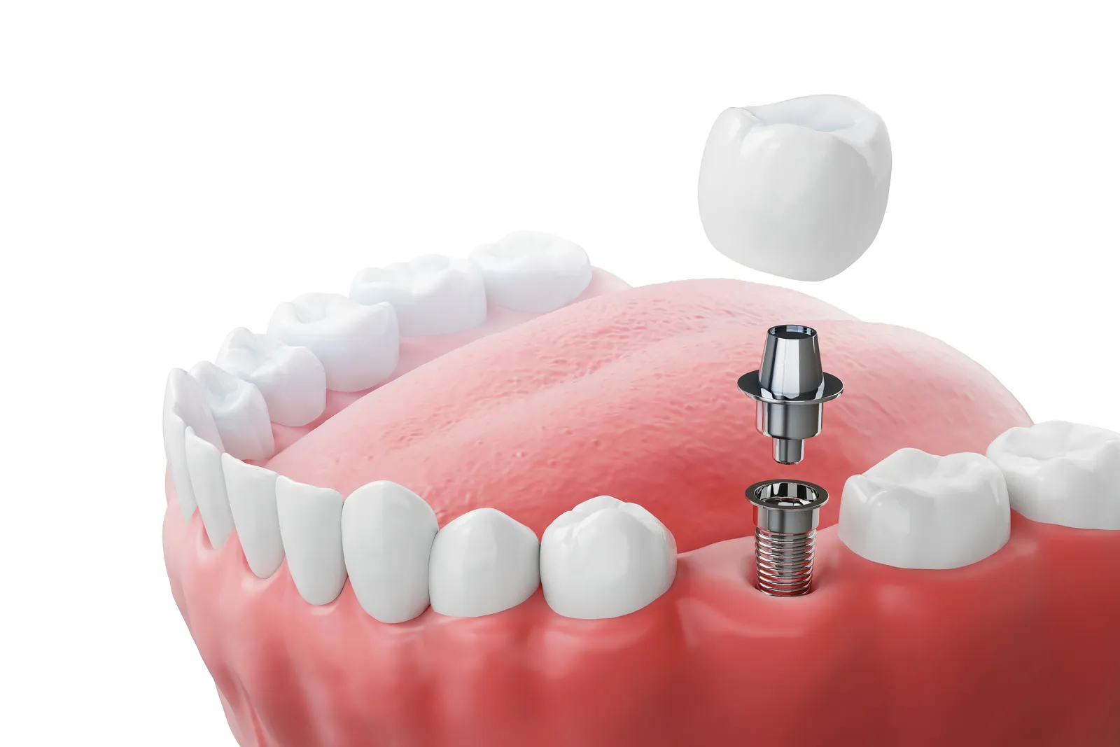 Single dental implant with a titanium post and crown, replacing one missing tooth