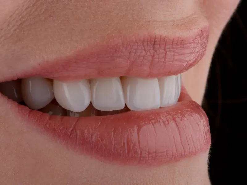 Porcelain veneers on front teeth, Plumas Family Dentistry, Yuba City, CA 95991